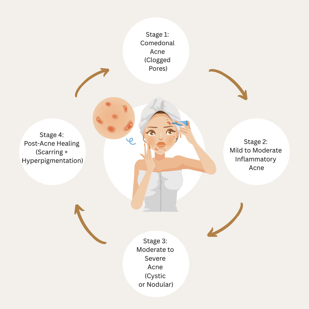 Understanding the Stages of Acne & How Face Reality Can Help